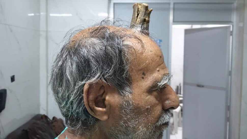 MP-யில் 74 வயது தாத்தாவின் தலையில் முளைக்கும் "பிசாசின் கொம்பு"... MP-யில் 74 வயது தாத்தாவின் தலையில் முளைக்கும் "பிசாசின் கொம்பு"...