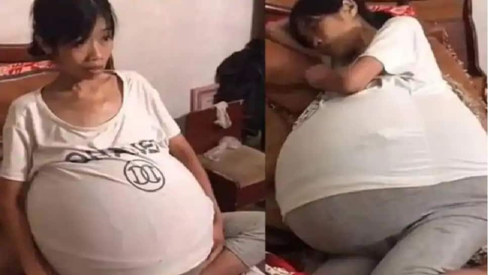 பலூன் போல பெருத்துக் கொண்டே போகும் வயிறு; மர்மமான நோய்.. அவதிப்படும் பெண்.. பலூன் போல பெருத்துக் கொண்டே போகும் வயிறு; மர்மமான நோய்.. அவதிப்படும் பெண்..