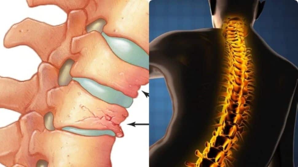 Osteoporosis: எலும்பு மெலிதல் நோயிலிருந்து தப்பிக்க கால்ஷியம் மட்டும் போதாது ..!! 