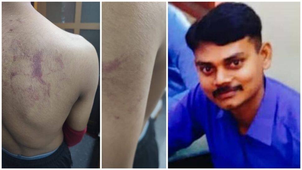 சட்டை இறுக்கமாக அணிந்ததற்காக அடித்த ஆசிரியர் - மருத்துவமனையில் மாணவன்