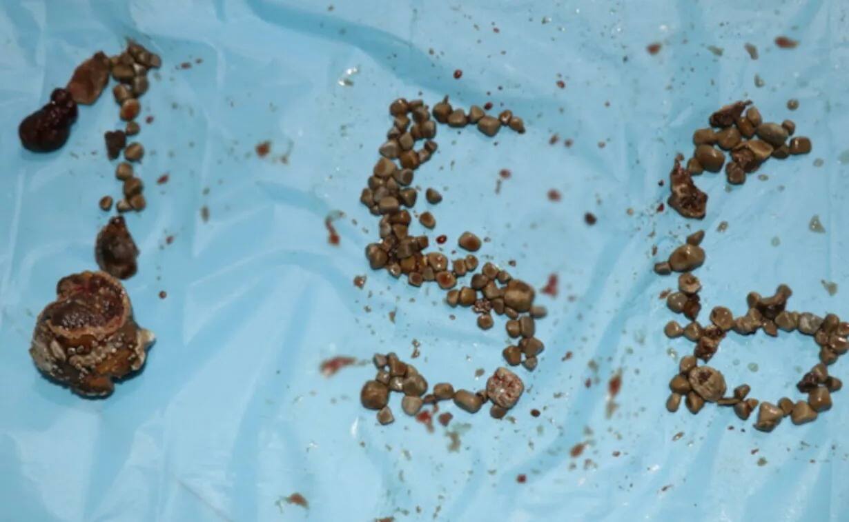 நோயாளியின் சிறுநீரகத்தில் இருந்த 156 கற்களை துரிதமாக செயல்பட்டு அகற்றிய மருத்துவர்கள்!