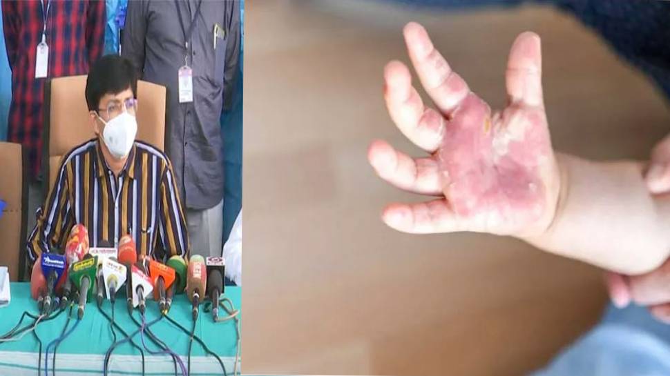 தக்காளி வைரஸ்? தக்காளிக்கும் இதற்கும் சம்மந்தம் இல்லை: ராதாகிருஷ்ணன் விளக்கம்!