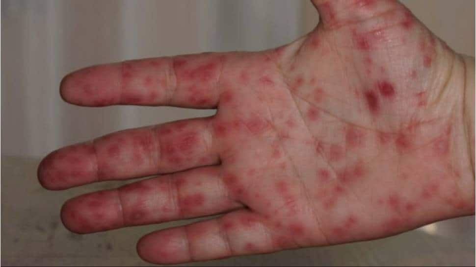 கேரளாவில் வேகமாகப் பரவும் தக்காளி காய்ச்சல்...80-க்கும் மேற்பட்ட குழந்தைகள் பாதிப்பு