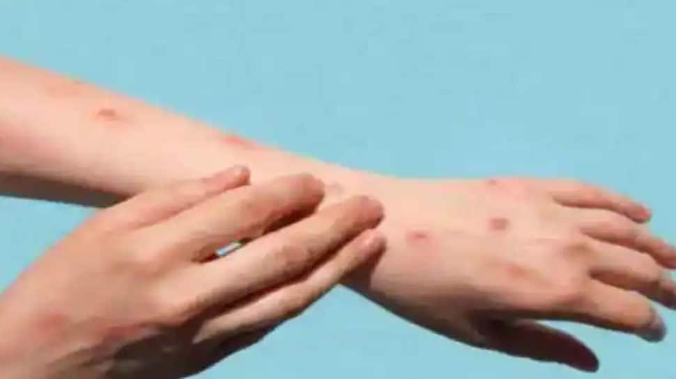 ஆப்பிரிக்காவுக்கு வெளியே குரங்கு அம்மையால் முதல் மரணம்: ஸ்பெயின், பிரேசில் நாடுகளில் பீதி