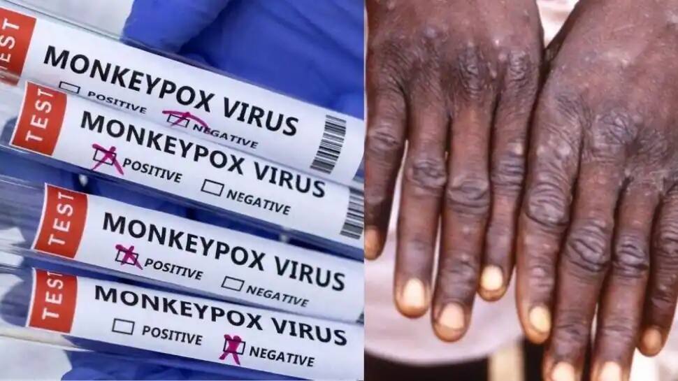 கேரளாவில் மேலும் ஒருவருக்கு குரங்கு அம்மை; பீதியை கிளப்பும் Monkeypox