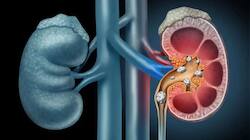 Health Alert: சிறுநீரக கல் இருந்தால் ‘இந்த’ உணவுகளுக்கு NO சொல்லுங்க!