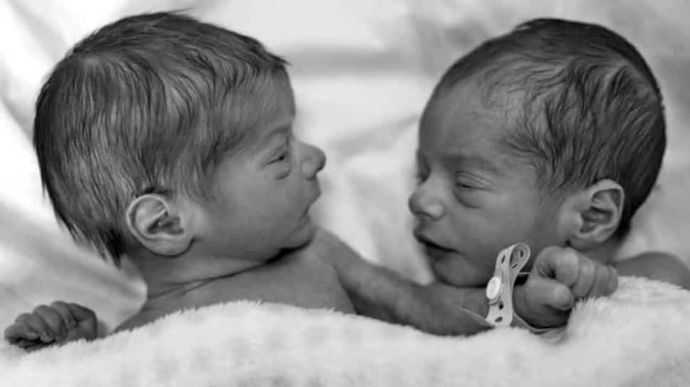 இது என்னடா புதுசா இருக்கு; இரட்டை குழந்தை ஆனா இரட்டையர்கள் இல்ல