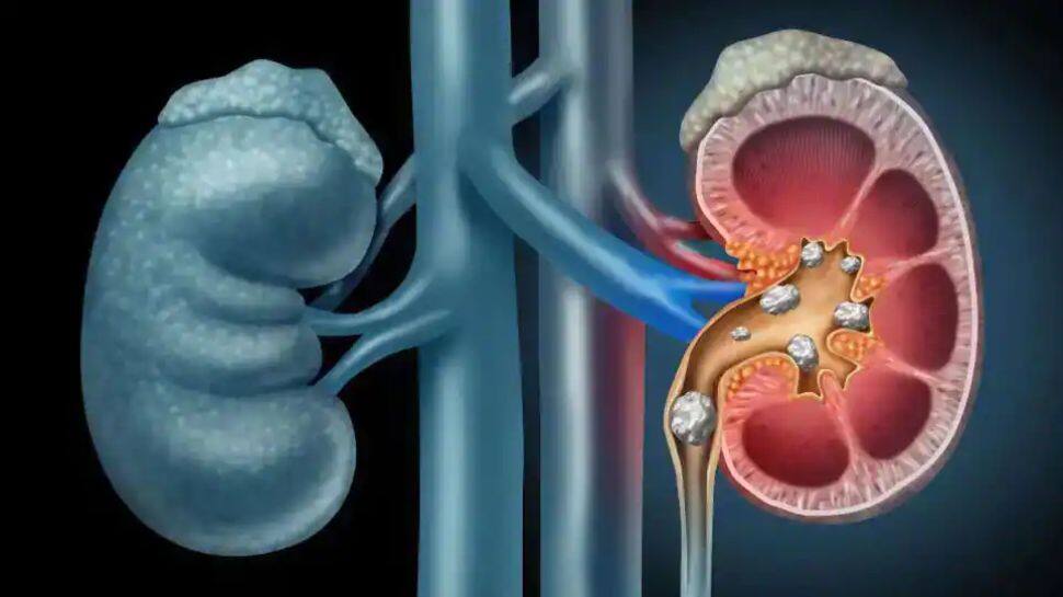  Kidney Health: சிறுநீரக கற்கள் அபாயத்தை அதிகரிக்கும் ‘சில’ காய்கறிகள்..!