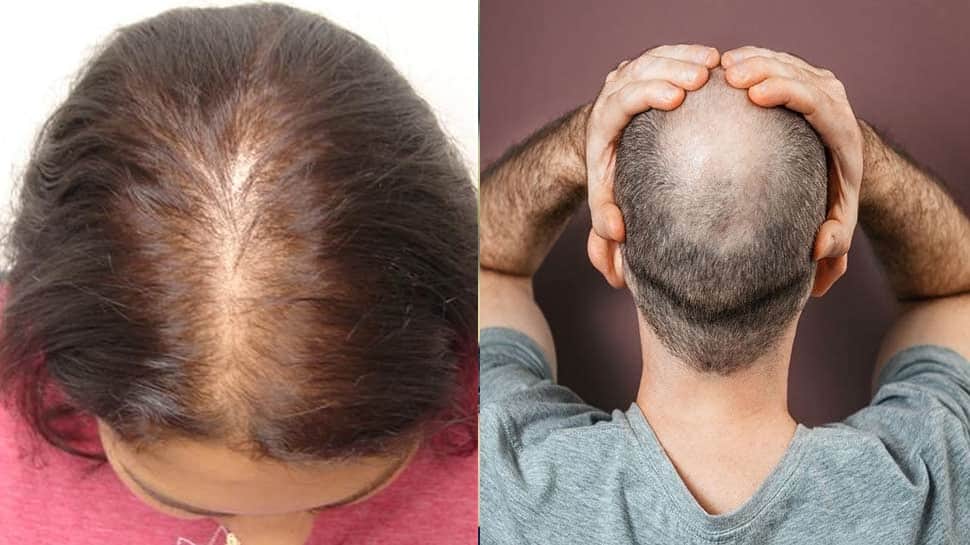 Hair Loss | இந்த வைட்டமின் குறைபாட்டால் முடி உதிர்வு கட்டாயம் ஏற்படும் ...