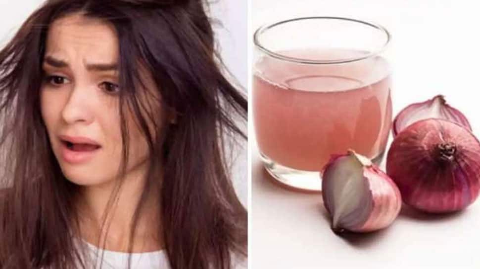 Onion for Dandruff Use Onion in this way for long, strong hair