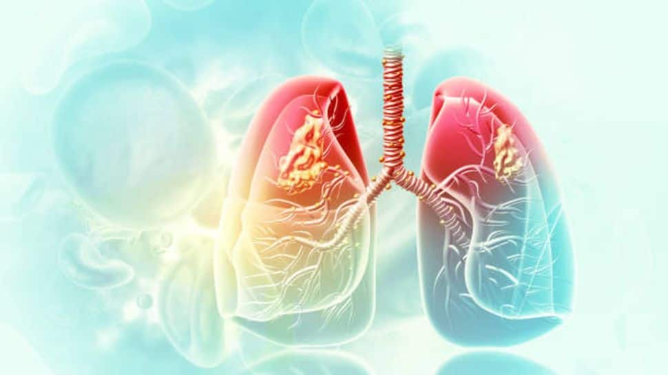 நுரையீரல் புற்றுநோய் அறிகுறிகள் இவை... புறக்கணிக்காதீர்கள்..!