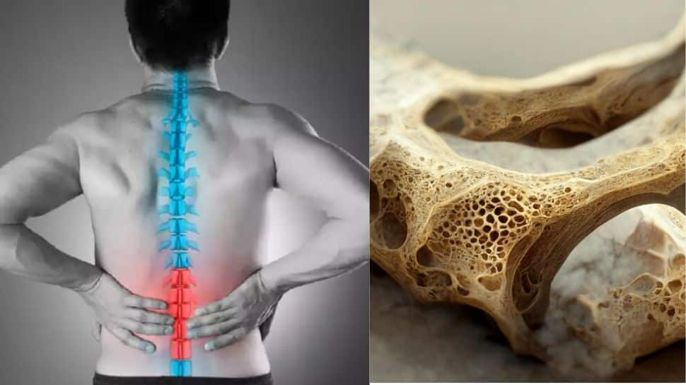 Vitamin D Deficiency & Spinal Cord Edema எச்சரிக்கை! விட்டமின் டி