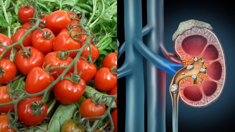 Eating Tomato Cause Kidney Stone Problems Full Details தக்காளி சாப்பிட்டால் சிறுநீரக கல்