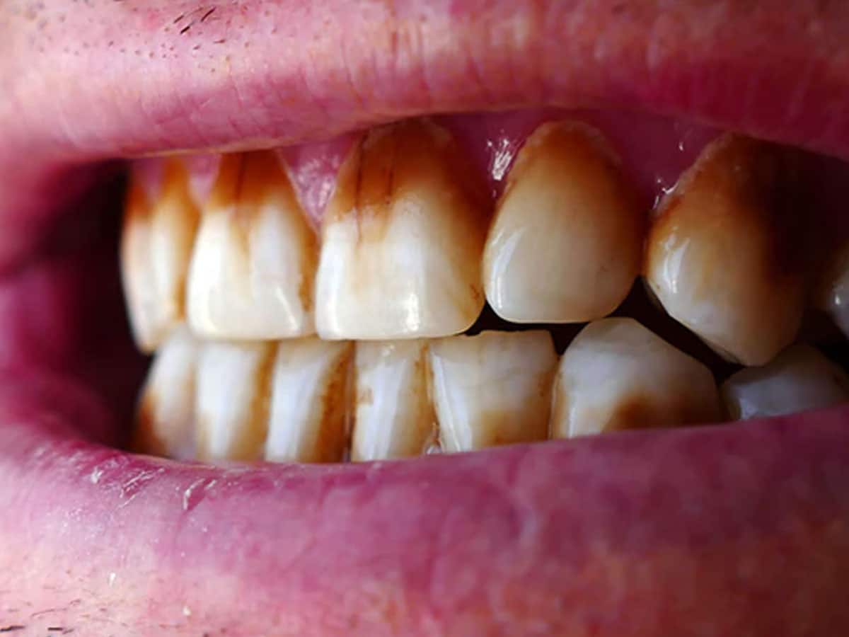 Teeth Whitening Home Remedy With Orange Peel தோற்றத்தைக் கெடுக்கும்