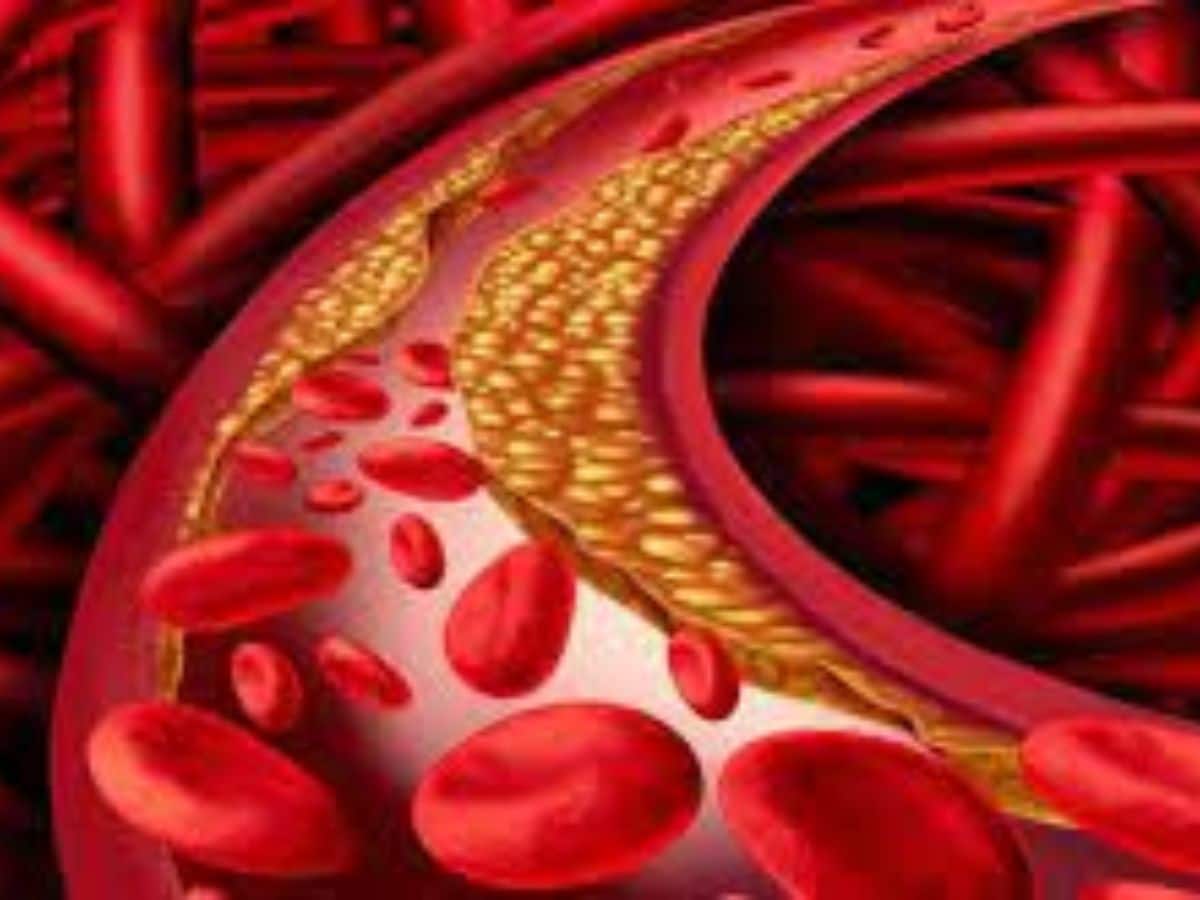 Low HDL Cholesterol Symptoms HDL கொலஸ்ட்ரால் குறைந்தால் இந்த