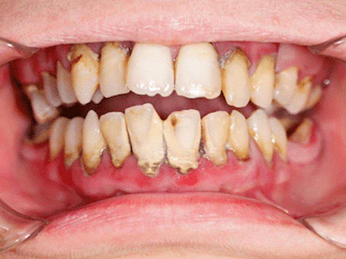 Teeth Whitening Tips Home Remedies மஞ்சள் மஞ்சளா பற்கள் அசிங்கமா