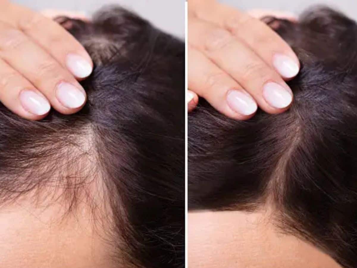 வழுக்கை விழுவதை தவிர்க்க வேண்டுமா? ‘இதை’ செய்து பாருங்கள்! வழுக்கை விழுவதை தவிர்க்க வேண்டுமா? ‘இதை’ செய்து பாருங்கள்!