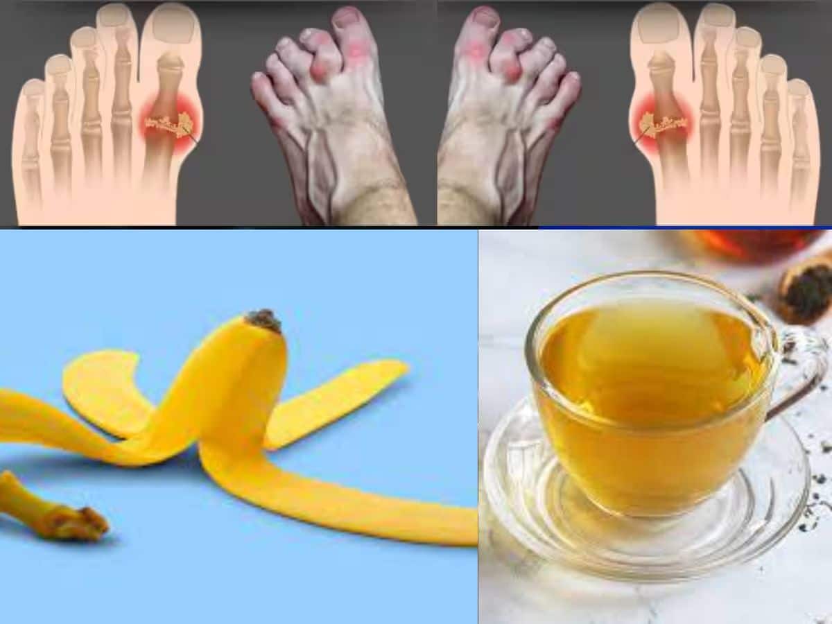 Good Gout Health Uric Acid Management With Banana Tea Uric Acid