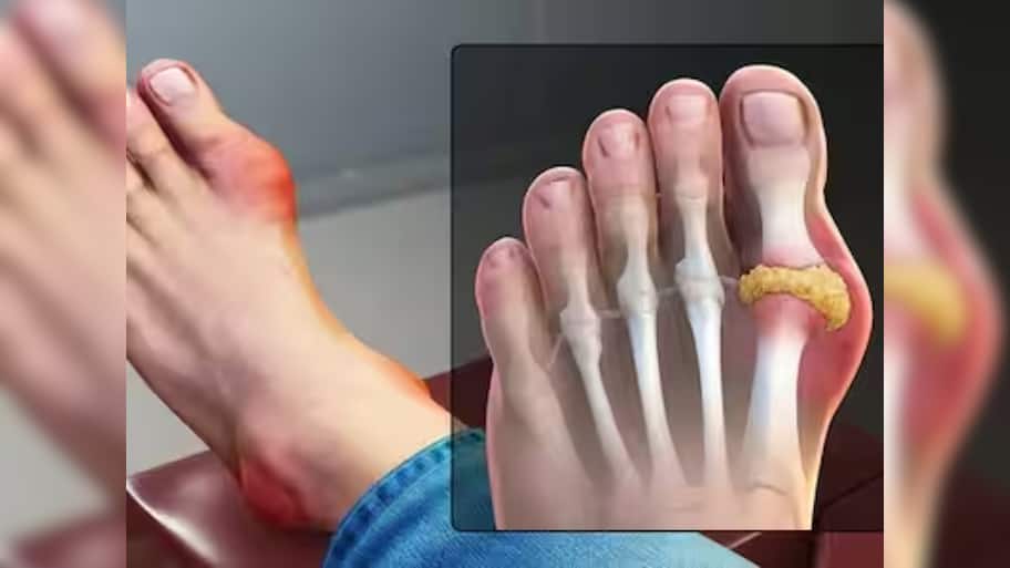 Uric Acid Level: யூரிக் அமிலத்தை ஒழித்துக் கட்டும் ‘சூப்பர்’ டிரிங்க்ஸ்!