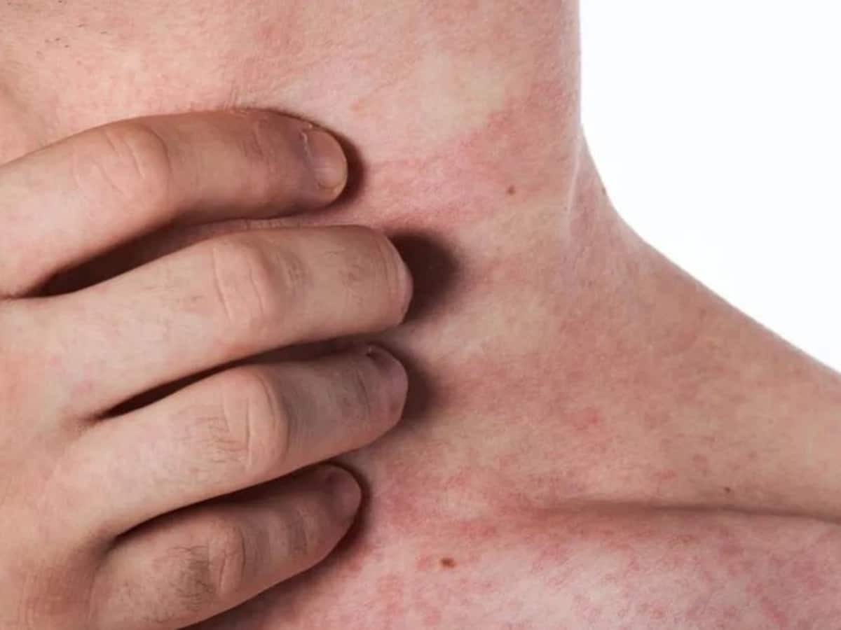 reason-behind-prickly-heat-in-the-body-causes-and-treatment-for