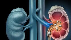 Kidney Stone : சிறுநீரக கல் பாதிப்பு...எதை சாப்பிடலாம்?எதை சாப்பிட கூடாது?