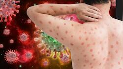 Mpox Update: பெரியம்மை தடுப்பூசி குரங்கு அம்மை வைரஸ் தாக்குதலை தடுக்குமா...