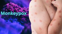 Monkeypox Virus: குரங்கு அம்மை அறிகுறிகளுடன் எய்ம்ஸ் வந்த நோயாளி...!