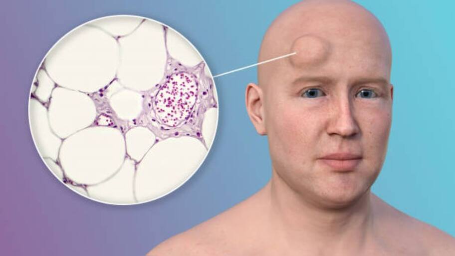 Causes of Fatty Lumps in the Body and How to Treat Them | உடலில் ...