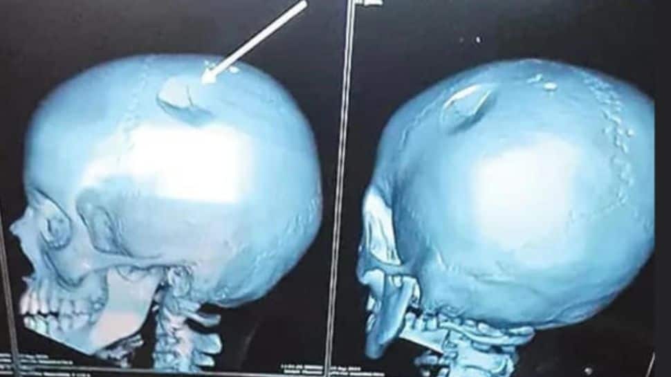 லஞ்ச் பாக்ஸால் அடித்த டீச்சர்..குழந்தையின் மண்டை ஓட்டில் fracture! என்ன நடந்தது?