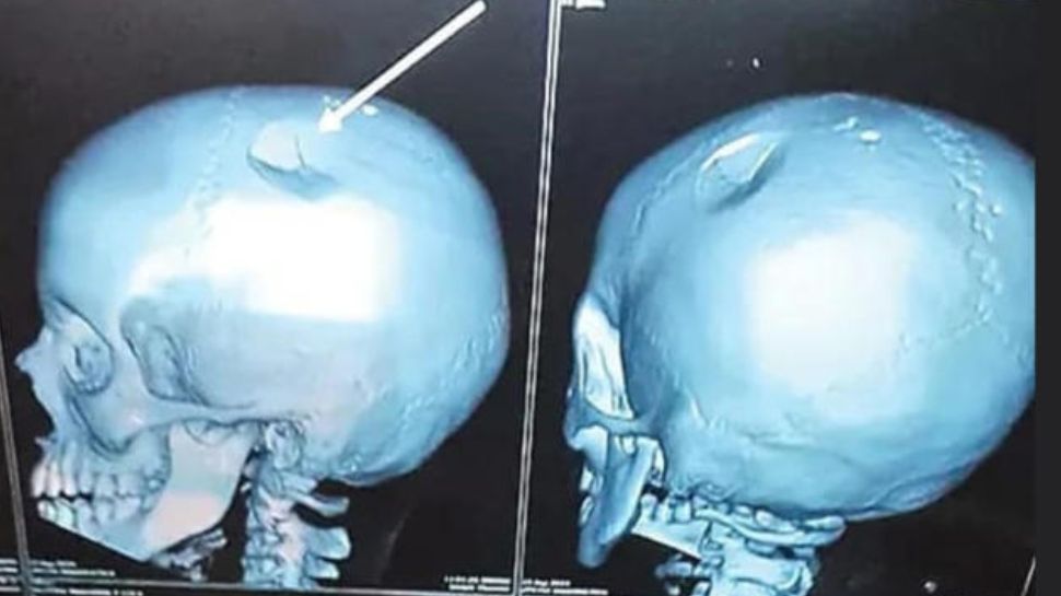 லஞ்ச் பாக்ஸால் அடித்த டீச்சர்..குழந்தையின் மண்டை ஓட்டில் fracture! என்ன நடந்தது? லஞ்ச் பாக்ஸால் அடித்த டீச்சர்..குழந்தையின் மண்டை ஓட்டில் fracture! என்ன நடந்தது?