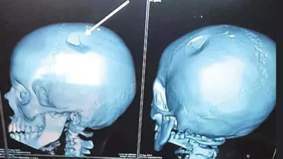 லஞ்ச் பாக்ஸால் அடித்த டீச்சர்..குழந்தையின் மண்டை ஓட்டில் fracture! என்ன நடந்தது?