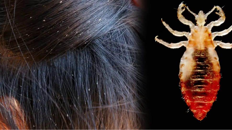 பேன் தொல்லையால் உயிரே பாேச்சு! 12 வயது சிறுமிக்கு நேர்ந்தது இதுதான்..உஷாரா இருங்க..