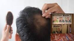 Hair Fall இளைஞர்களை குறிவைத்து... போலி டாக்டர்கள் செய்த மோசடி - சென்னையில் பகீர்