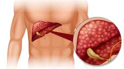 Liver Cirrhosis அறிகுறிகள் என்ன? மருத்துவர் சொல்லும் முக்கிய தகவல்