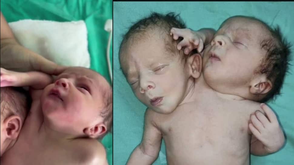 Baby Born With 2 Heads, 3 Arms