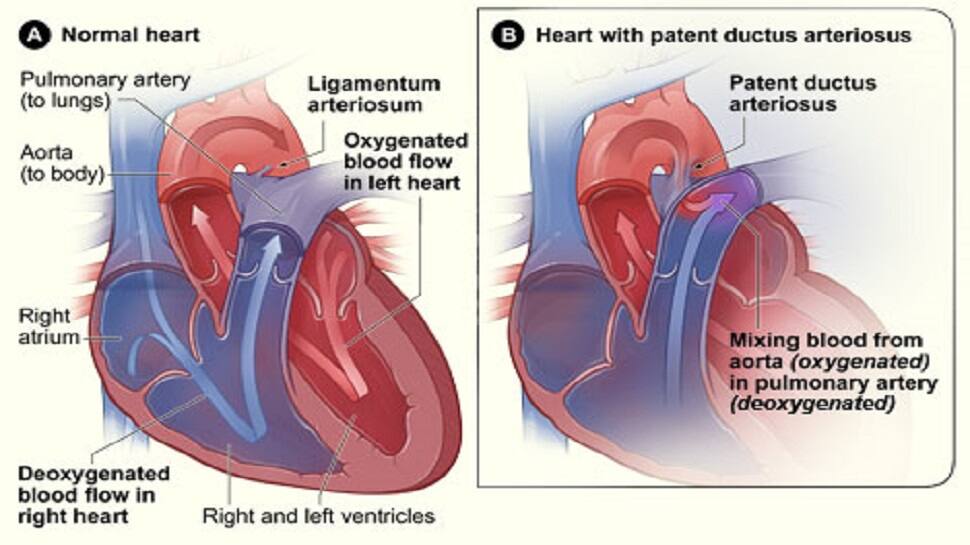 ductus arteriosus