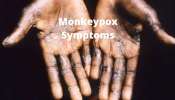 Monkeypox: அதிகரிக்கும் குரங்குக் காய்ச்சல்: அவசரக் கூட்டத்தைக் கூட்டும் WHO
