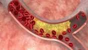 Bad Cholesterol: இந்த அறிகுறிகள் இருக்கா? அப்போ எச்சரிக்கையா இருக்கணும் 