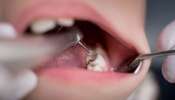 Teeth Cavity: பல் வலி, பல் சொத்தை, பல் கூச்சம் வராமல் தடுக்க டிப்ஸ்