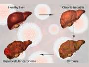 Liver Health: கல்லீரல் பாதிப்பை உணர்த்தும் சில அறிகுறிகள்!