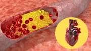 மாரடைப்புக்கு காரணமான LDL கொலஸ்ட்ராலை... எகிற வைக்கும் சில உணவுகள்