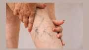 Varicose Veins: கால்களில் நரம்புகள் கதகளி ஆடுதா? இதை முதலில் படிங்க!!