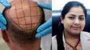 2 உயிரை பறித்த முடி மாற்று அறுவை சிகிச்சை! என்ன நடந்தது? முழு விவரம்!