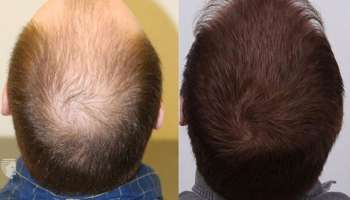 வழுக்கை முதல் மூட்டு வலி வரை; பல நோய்க்கு அருமருந்தாகும் ஊமத்தை இலை!  