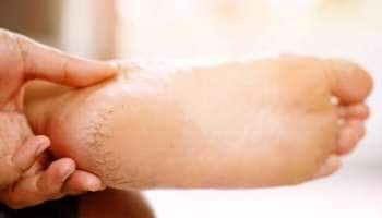 கால் பித்த வெடிப்பு சரி செய்ய ஓட்ஸுடன் இந்த ஒரு பொருள் போதும்