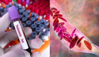 இரும்புச்சத்து குறைபாடு மற்றும் தலசீமியா இடையே உள்ள வித்தியாசம்