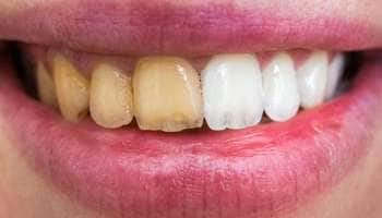 மஞ்சள் பற்களை முத்து போல் பளபளக்க வைக்க வெறும் 10 ரூபாய் போதும்