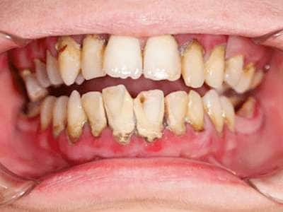 மஞ்சள் மஞ்சளா பற்கள் அசிங்கமா இருக்கா.. அப்போ இதை மட்டும் செய்யுங்கள்