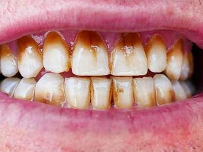 அசிங்கமான மஞ்சள் பற்கள் முத்து போல் ஜொலிக்க 'சூப்பர்' வீட்டு வைத்தியம்