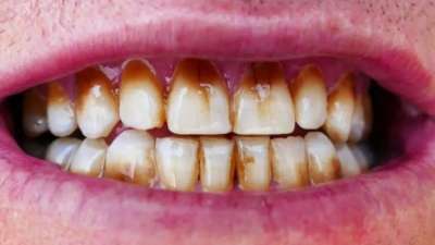 மஞ்சள் மஞ்சளேனு பற்கள் அசிங்கமாக இருக்கிறதா? டூத்பேஸ்டில் இதை சேர்க்கவும்